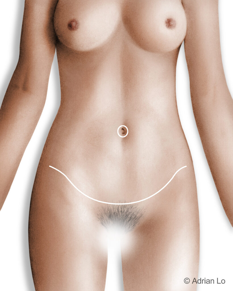 Lo - Tummy Tuck INCISION - Lower torso FEMALE_COLOR FINAL