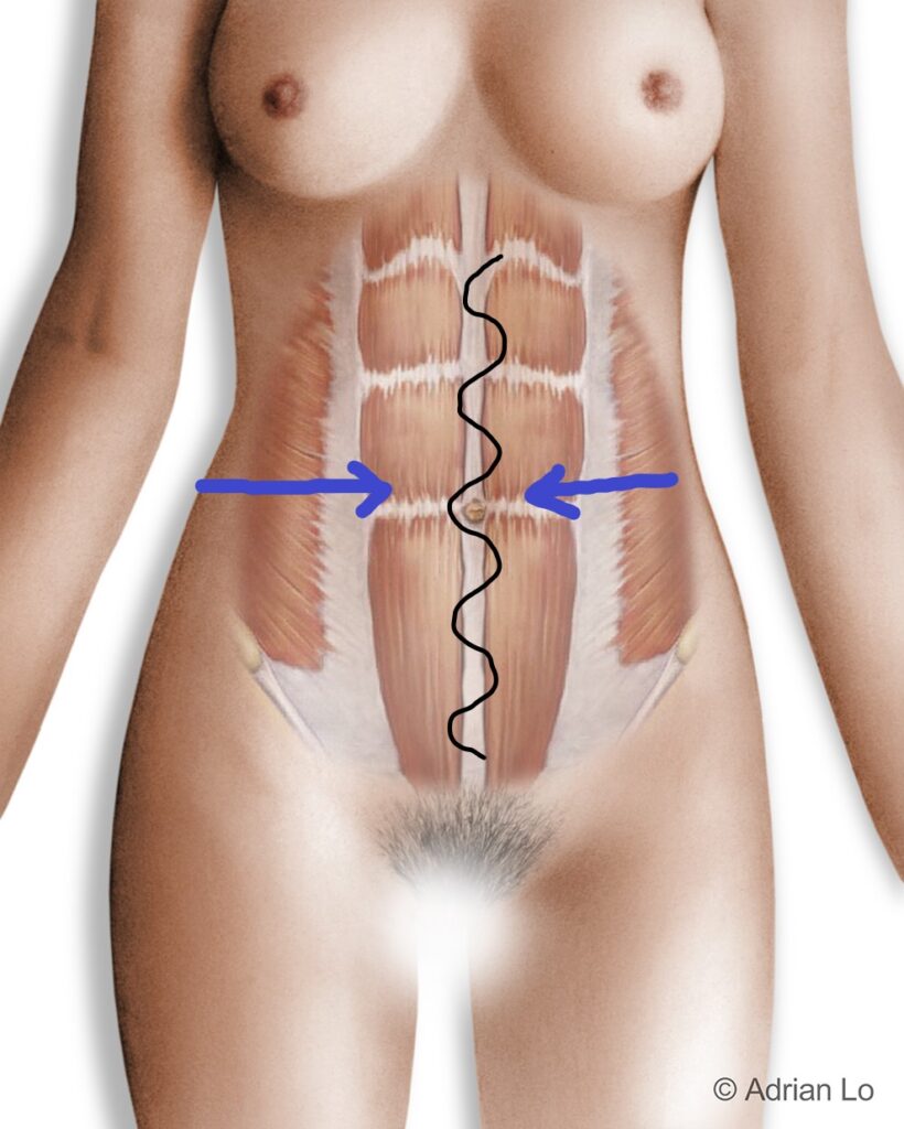Lo - Tummy Tuck MUSCLE REPAIR - abmuscles FINAL