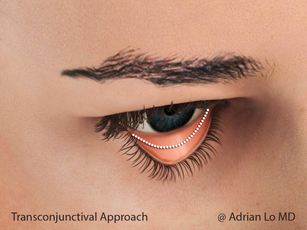 Lo - transconjunctival incision