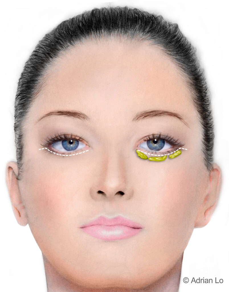 Lo_LOWER INCISION_Eyelid Surgery