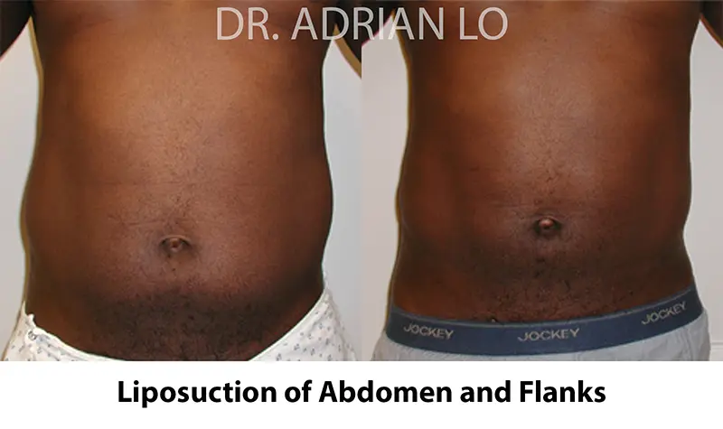 abdomen and flank lipo