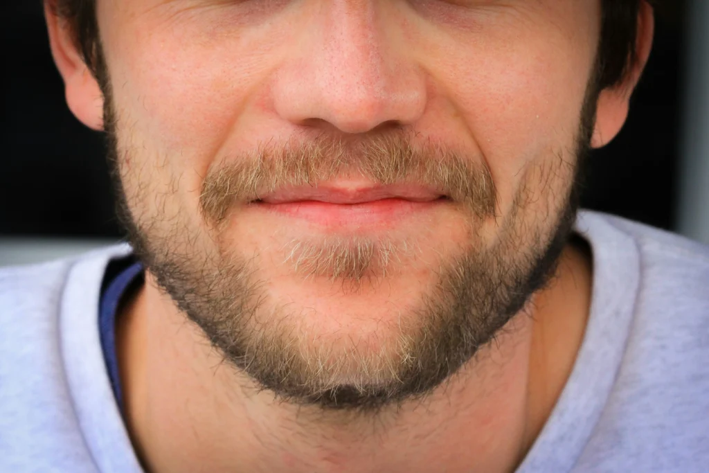 dermal filler nasolabial folds