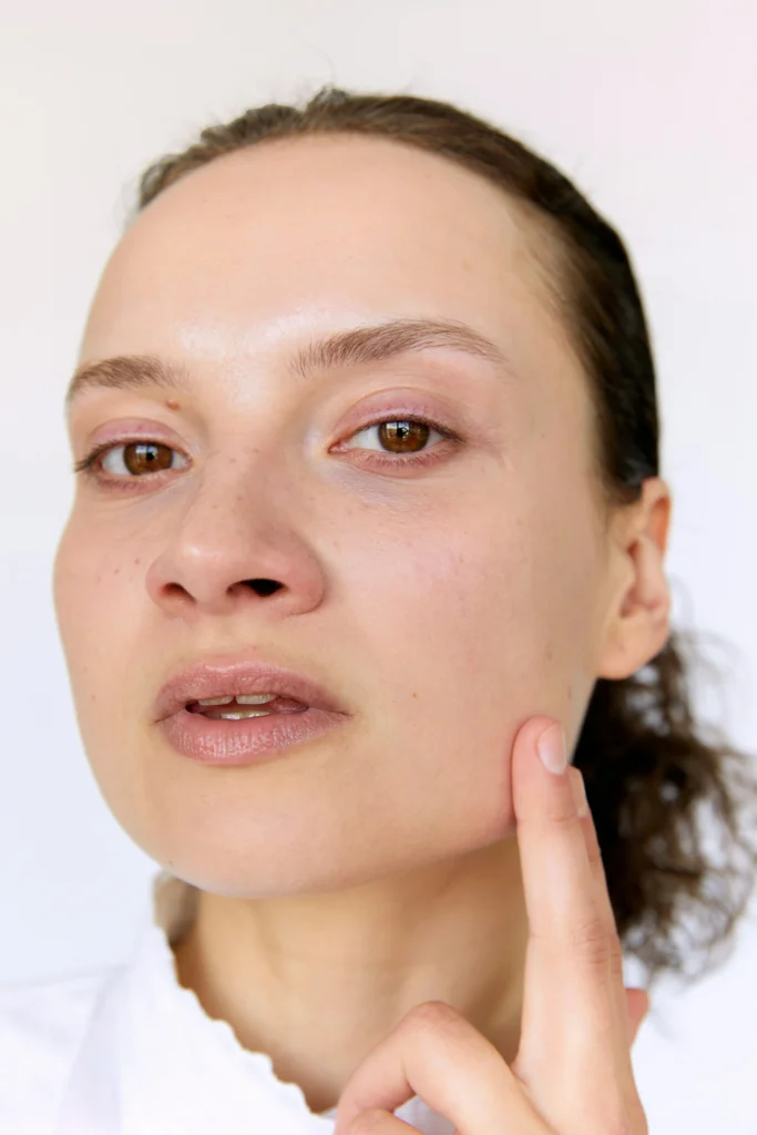 dermal filler nasolabial folds