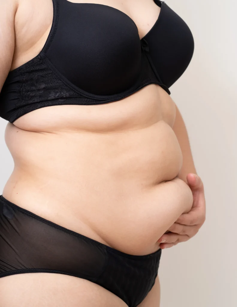 tummy tuck after pregnancy