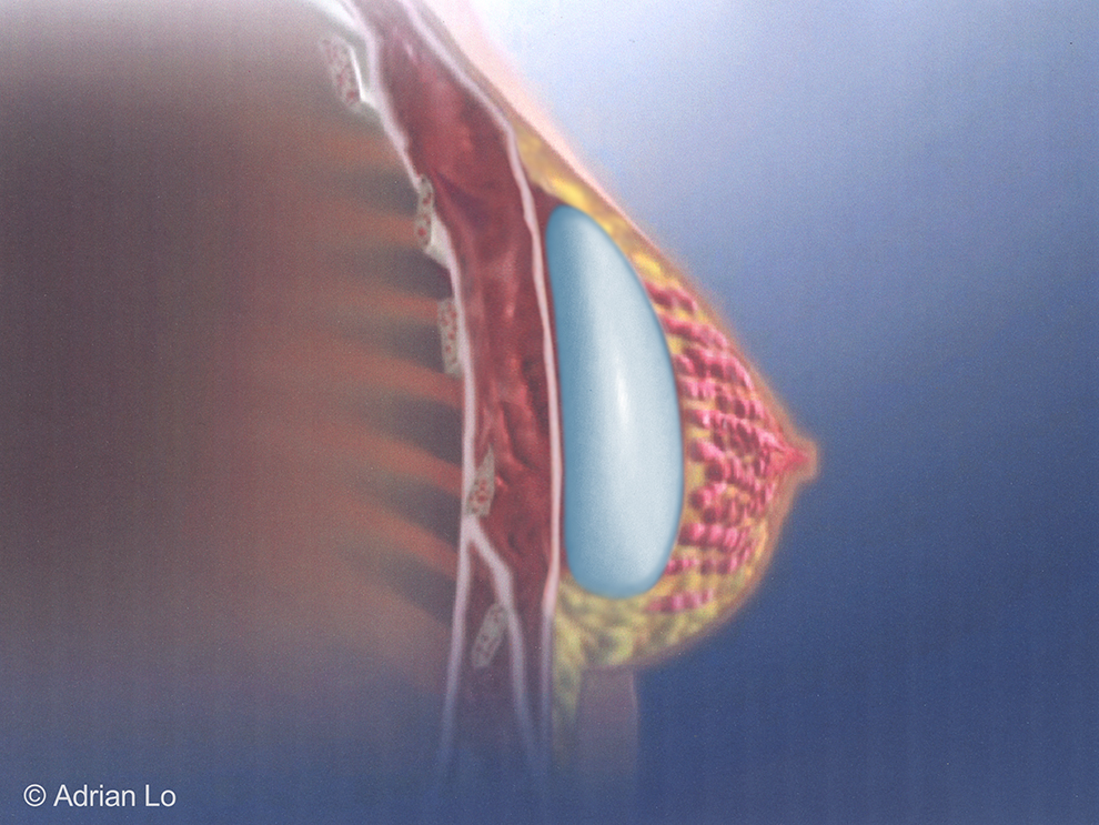 SUBGLANDULAR - Breast Implant_sub glandular_FINAL