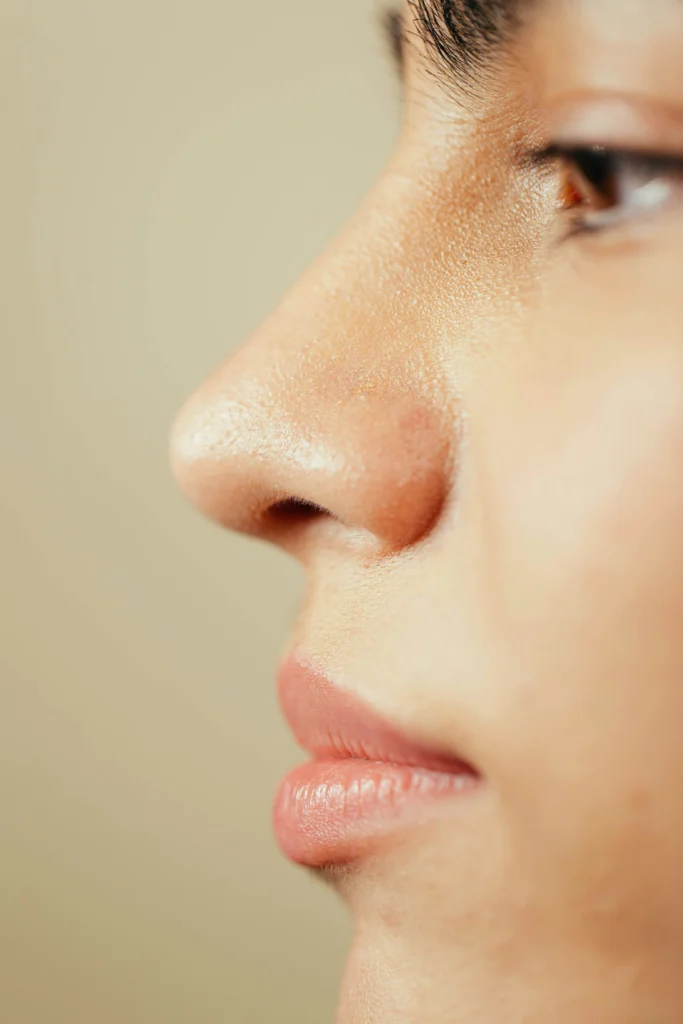 rhinoplasty swelling stages​