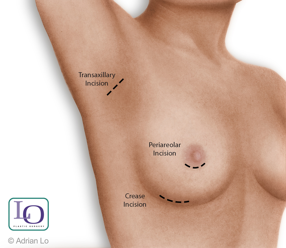Lo Breast Implant Incision Options