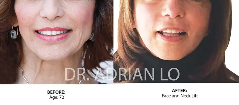 Before and After - Lo - face-neck-02a