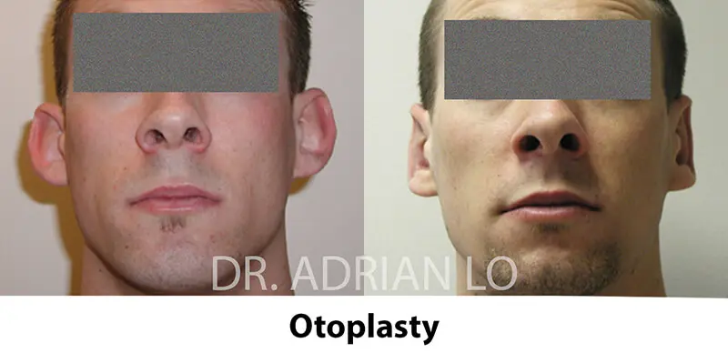 LO otoplasty-05a