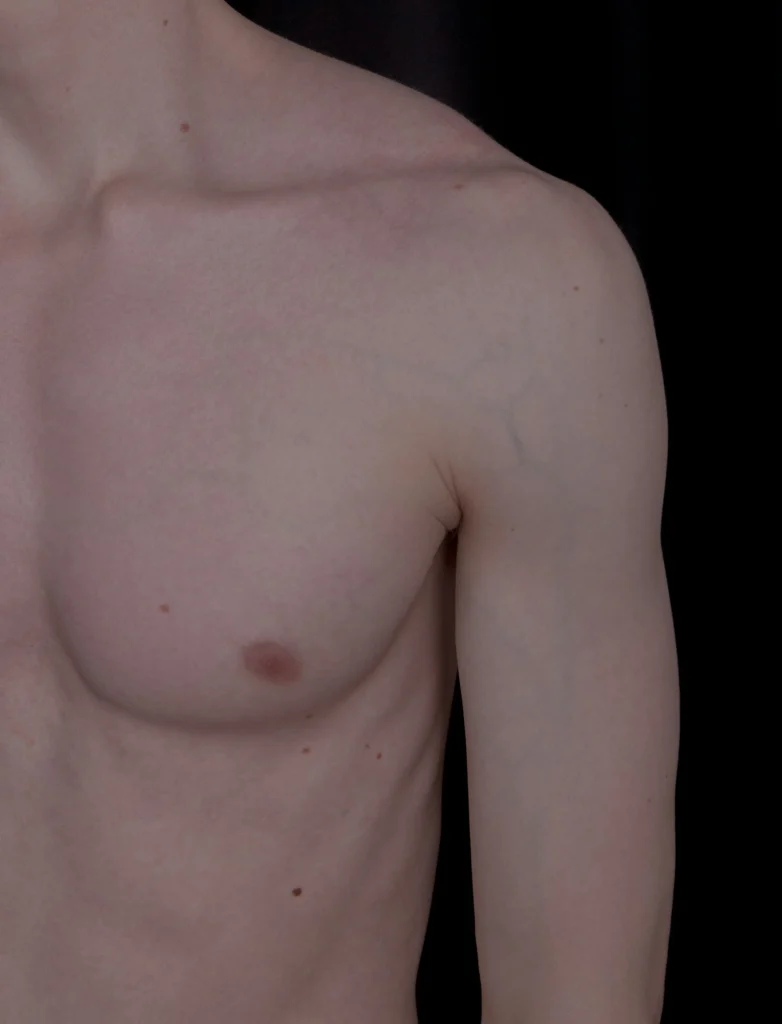 Natural gynecomastia resolution