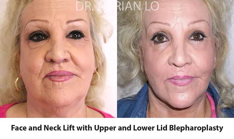 Before and After - Lo - facelift-08a