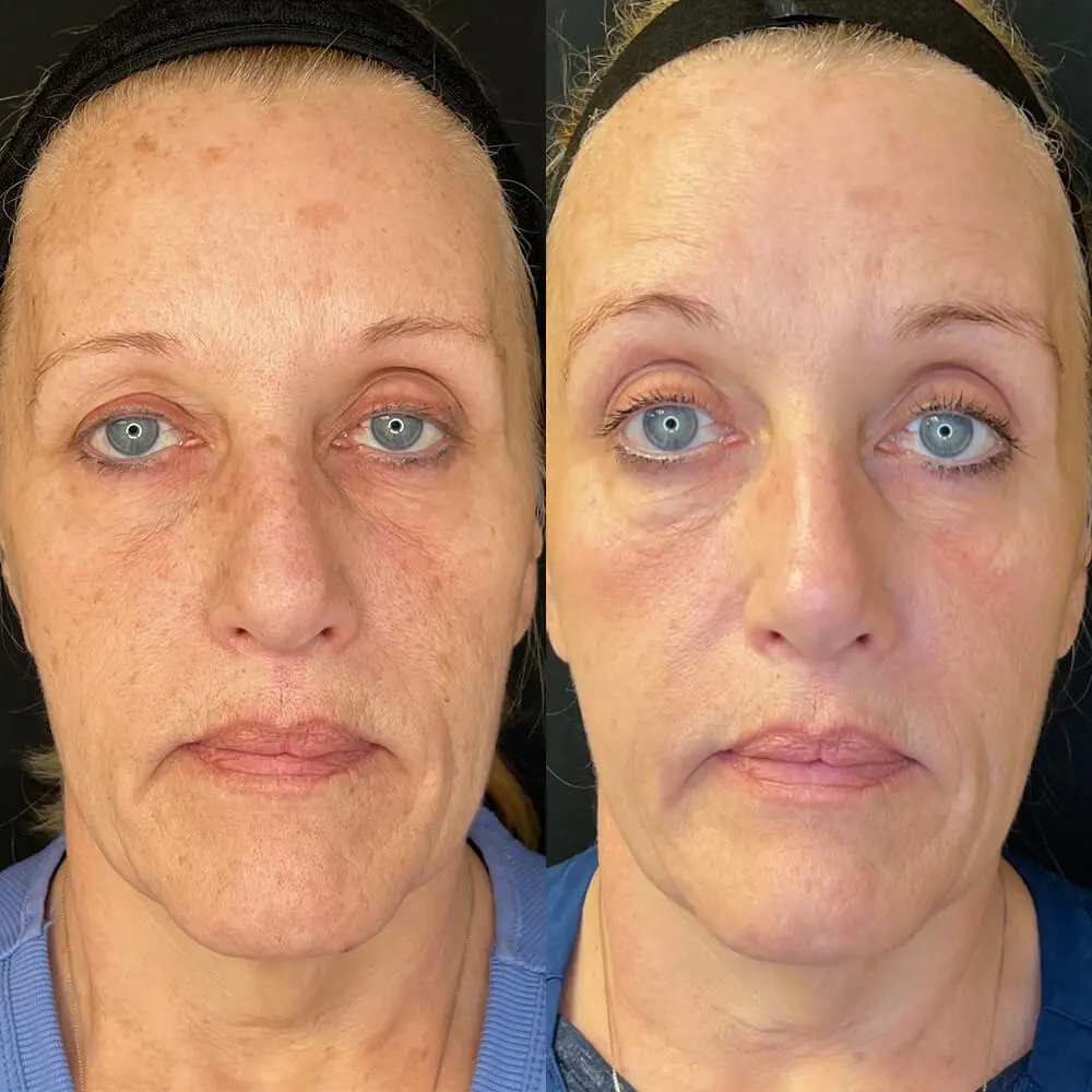 Lo Halo Before and After