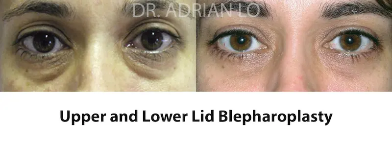 Before and After - Lo - eyelid-sugery-10