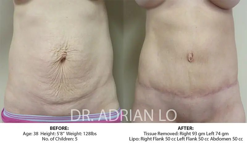 Lo before and after Tummy
