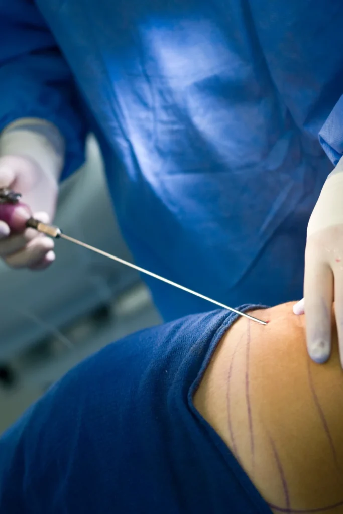 high-volume liposuction results