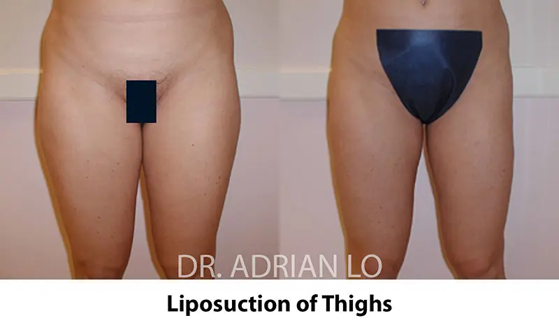 lipo-p-10 before and after Lo