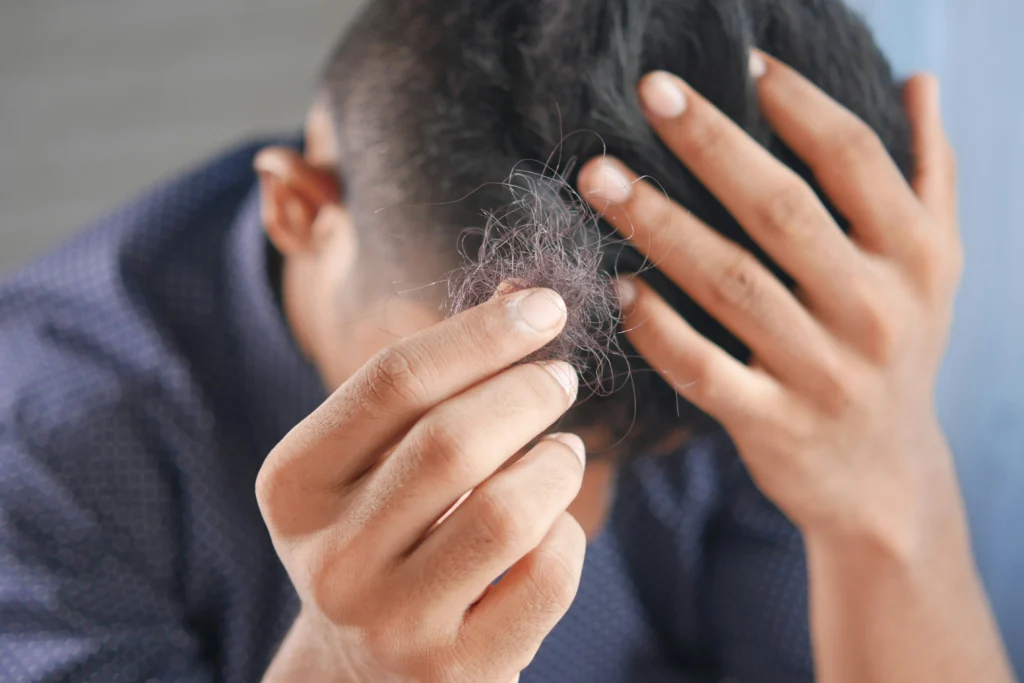 Image of a man holding a clump of fallen hair, experiencing hair loss and concerned about thinning