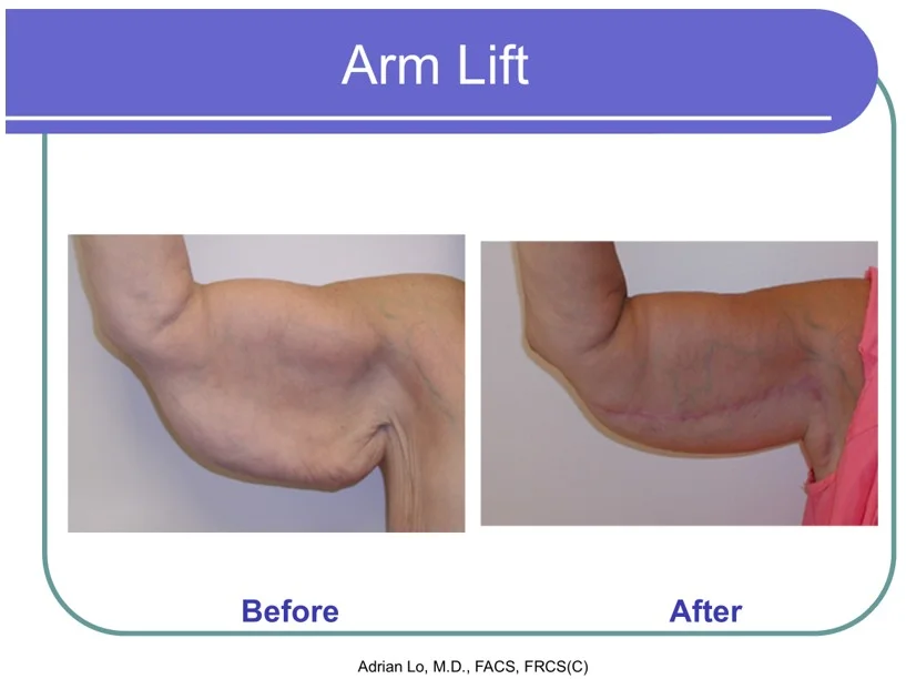 Image of arm lift before and after results showing reduced excess skin with inner arm scar