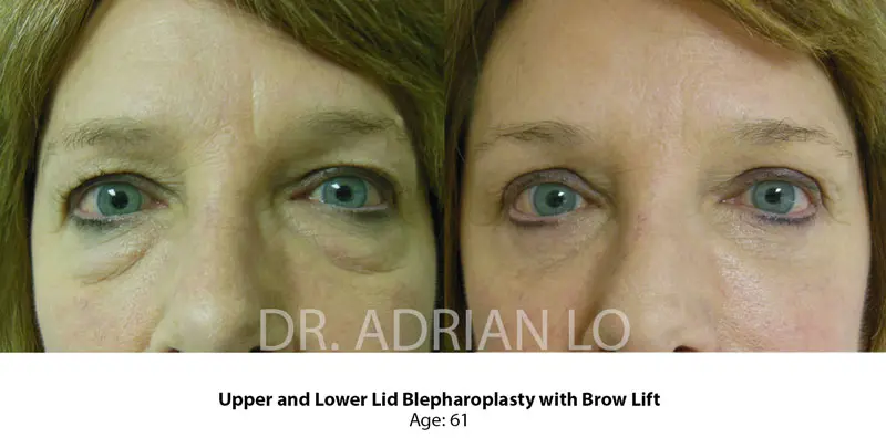 Image of blepharoplasty and eyebrow lift before results showing drooping upper eyelid closeup