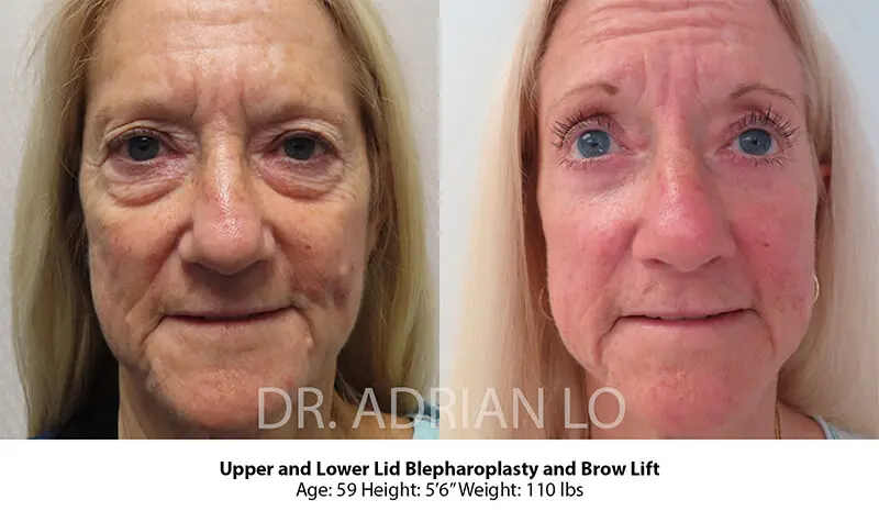 Image of elderly woman face showing signs of eyelid sagging before blepharoplasty and eyebrow lift.