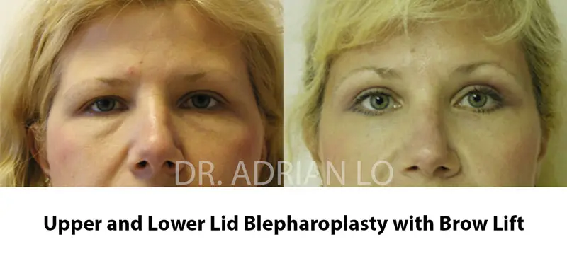 Image of woman with heavy brow and upper eyelid hooding before blepharoplasty and eyebrow lift