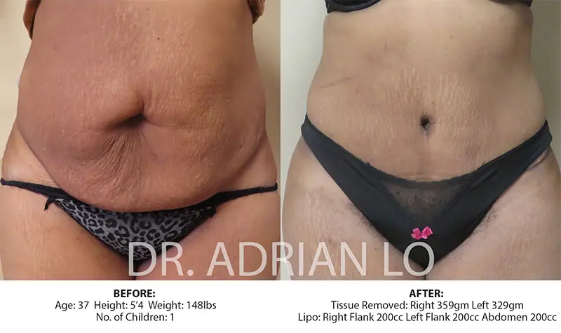 Tummy tuck before and after 