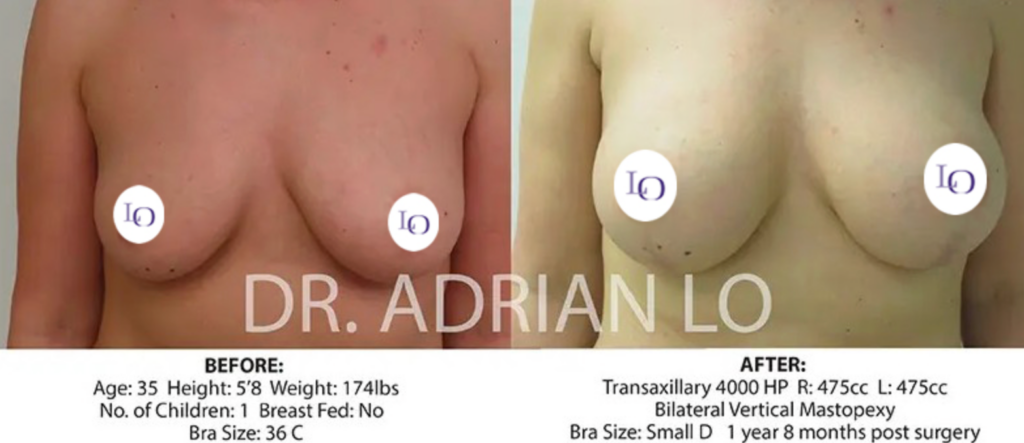 Brest lift before and after 