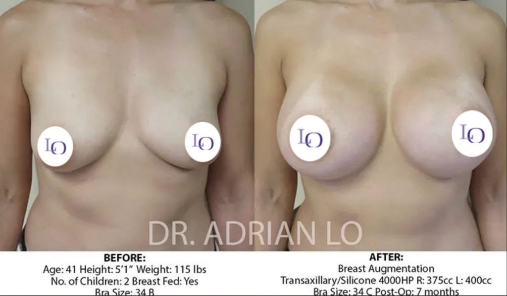 Breast lift before and after 
