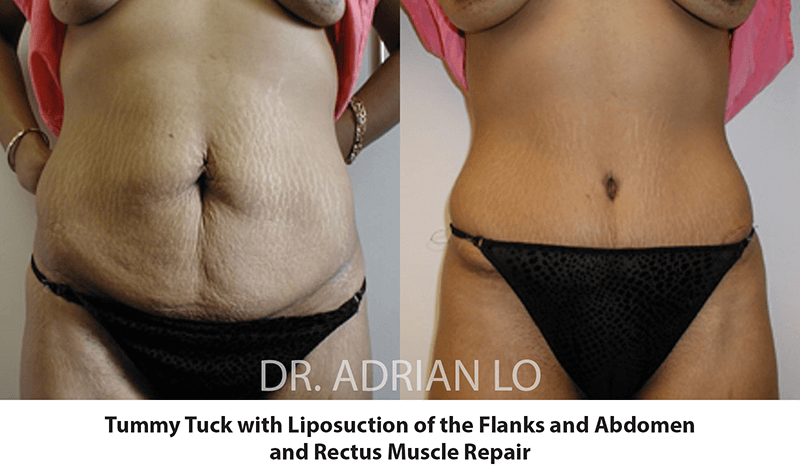 Tummy truck before and after images 