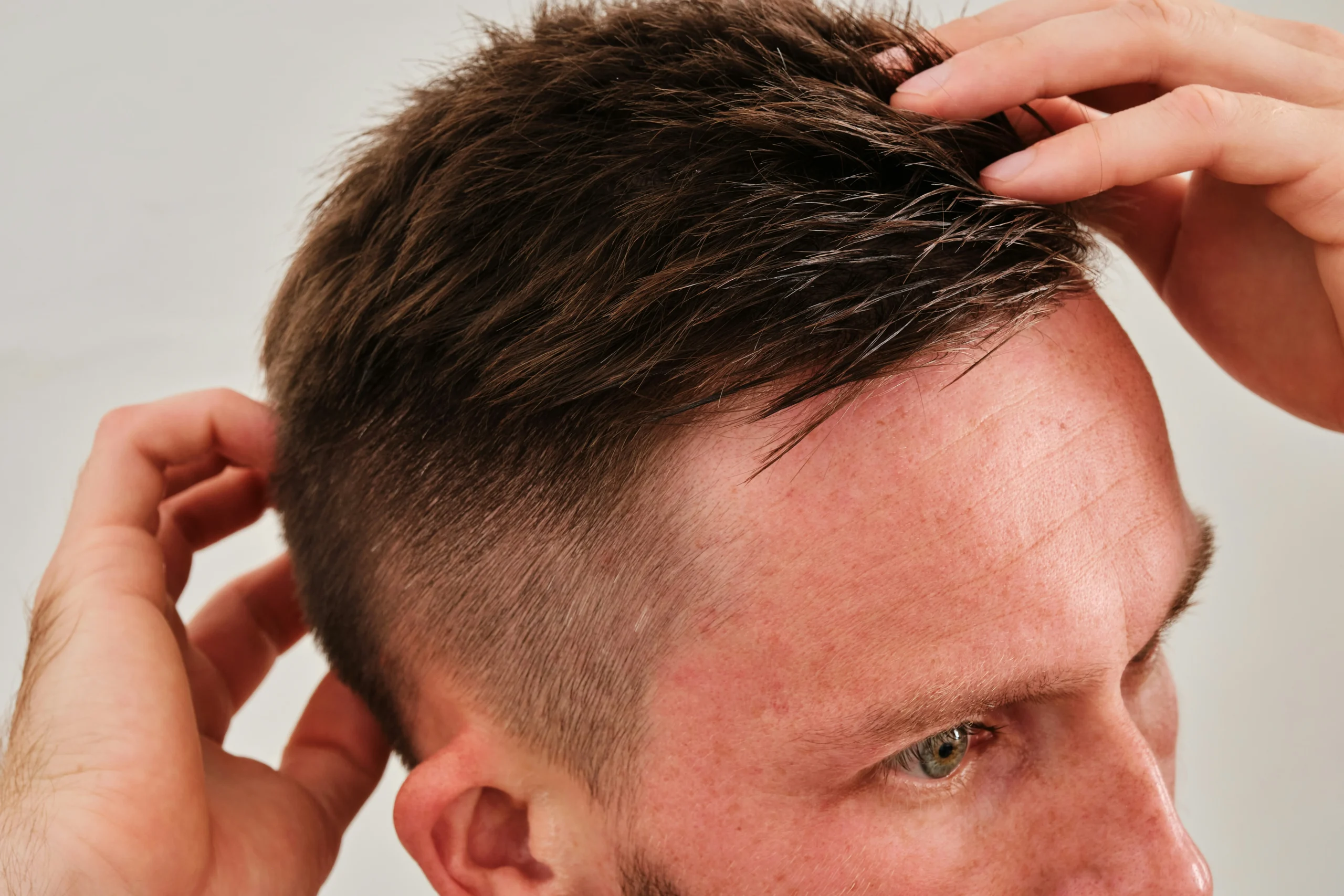 Image of a man examining his hairline, relevant to are hair transplants in Turkey safe