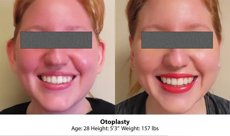 Image of female patient before and after otoplasty cost results at age 28