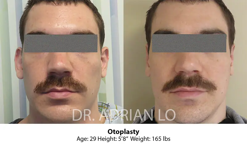 Image of male patient before and after otoplasty results at age 29