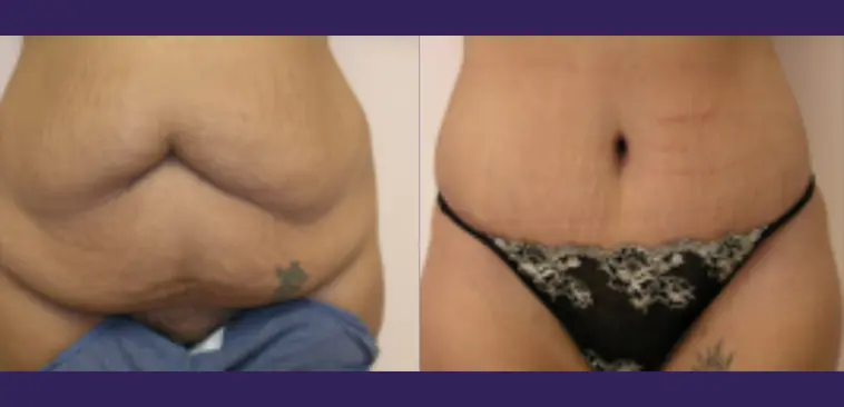 Image of tummy tuck before and after by Dr Adrian Lo in Philadelphia and New Jersey