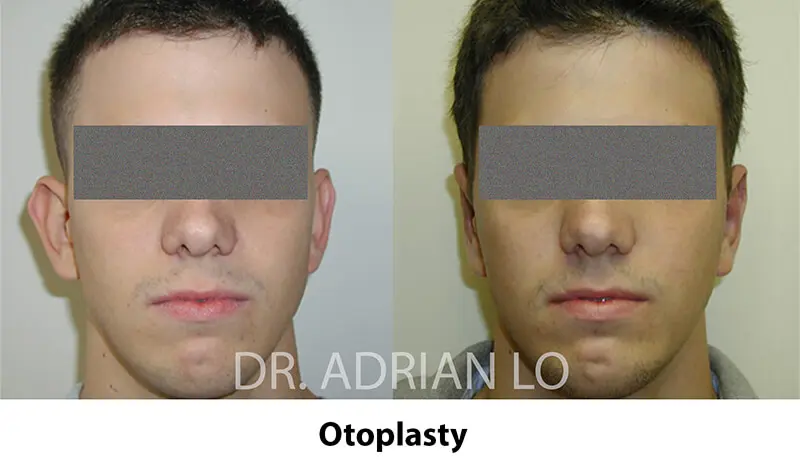 Image of young man showing ear pinning results from otoplasty procedure