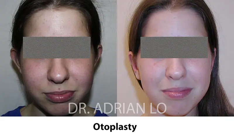 Image of young woman before and after otoplasty cost transformation front view