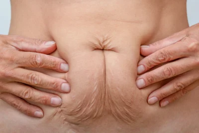 Image of excess skin around the navel before abdominoplasty