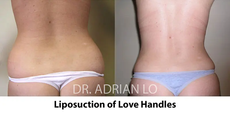 image of liposuction of love handles before and after results by Dr. Adrian Lo plastic surgeon