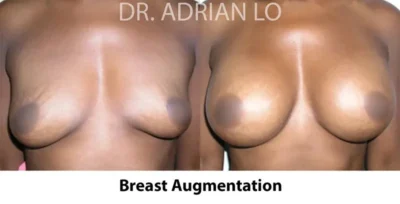 Image of breast implant sizes before and after breast augmentation surgery results