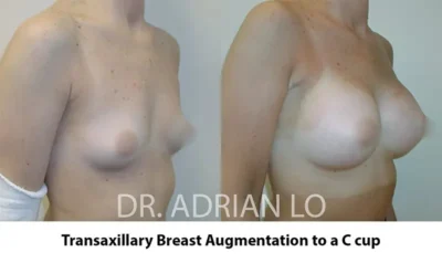 Image of breast implant sizes before and after transaxillary augmentation results to a C cup