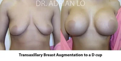 Image of breast implant sizes before and after transaxillary augmentation to a full C cup