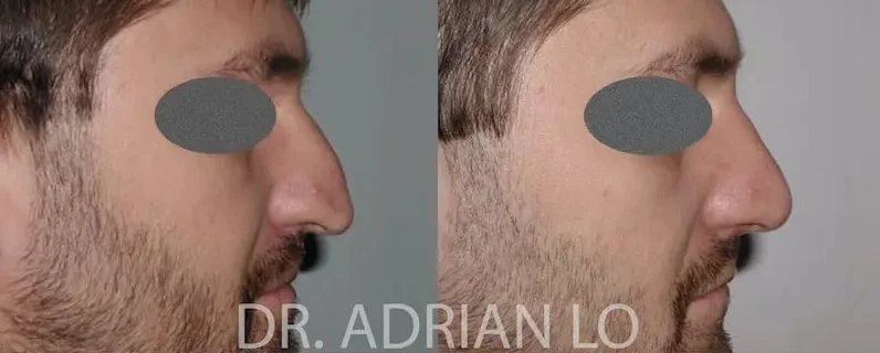 image of before and after male rhinoplasty results showing reduced dorsal hump