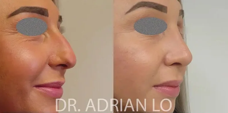 image of before and after nose reshaping surgery results in profile view