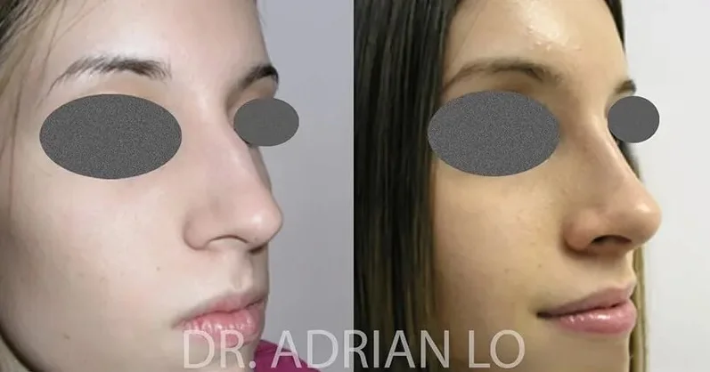 image of before and after profile results from nasal bridge reshaping