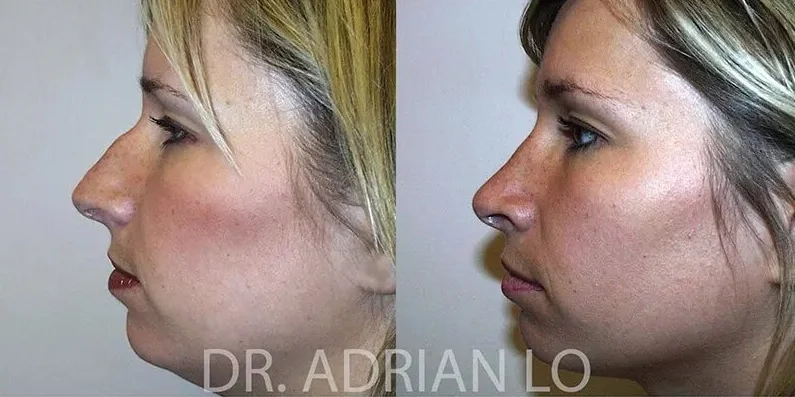 image of before and after profile rhinoplasty results showing tip refinement