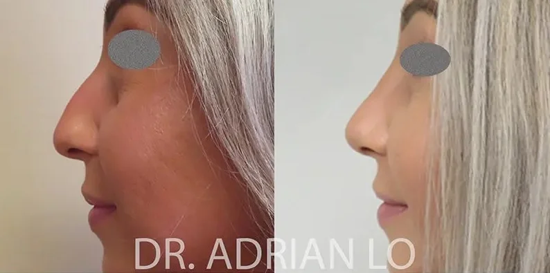image of before and after rhinoplasty in Cherry Hill results for a mature patient