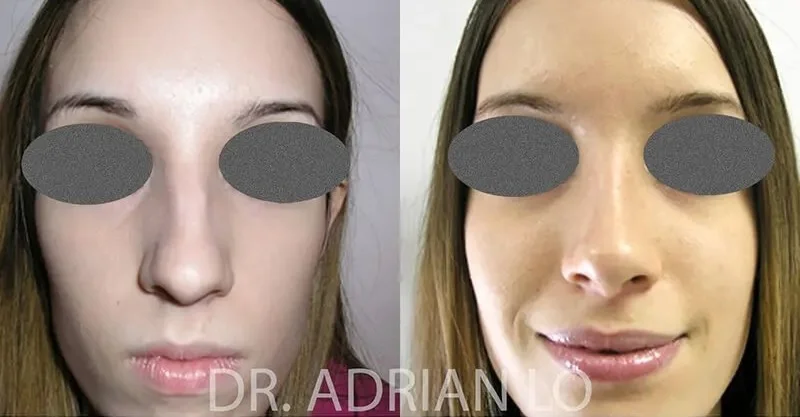 image of before and after rhinoplasty in Cherry Hill results, frontal view