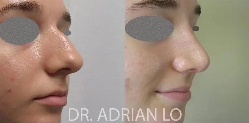 image of before and after rhinoplasty in Cherry Hill results in a young patient