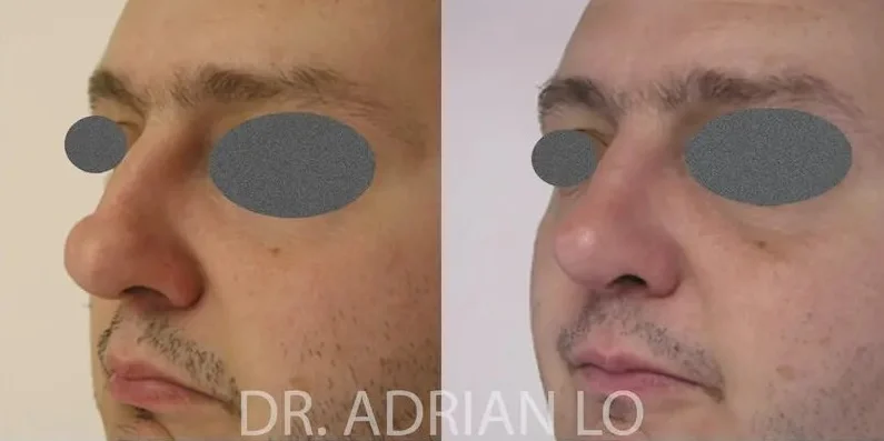 image of before and after rhinoplasty results improving nasal profile balance