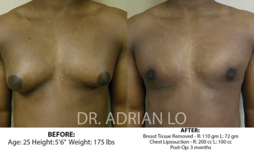 image of liposuction for gynecomastia results at three months post-op