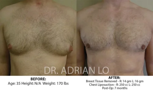 image of male breast reduction results at seven months post-op